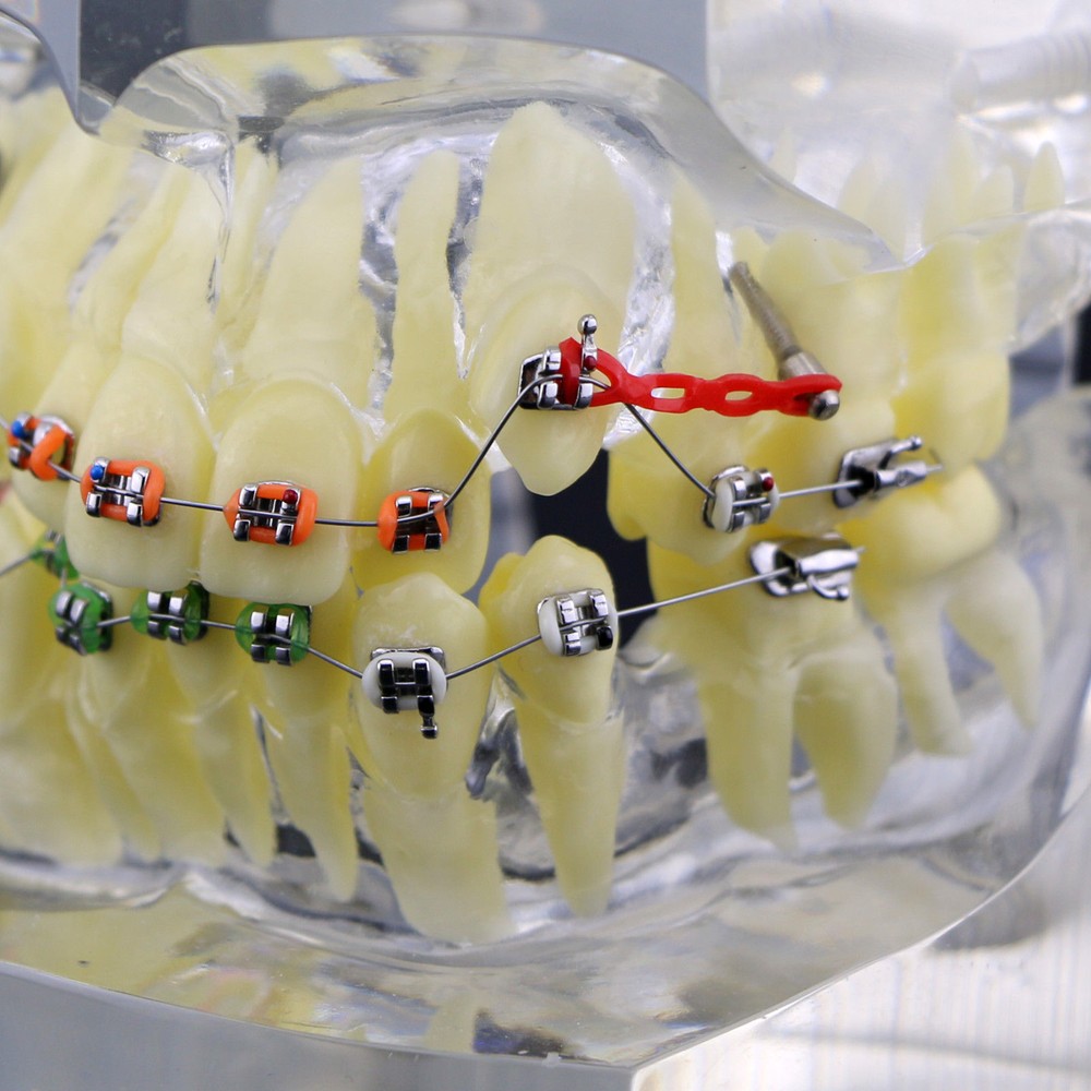 Dental Typodont Orthodontic Treatment Teeth Model Malocclusion Study w/ Bracket