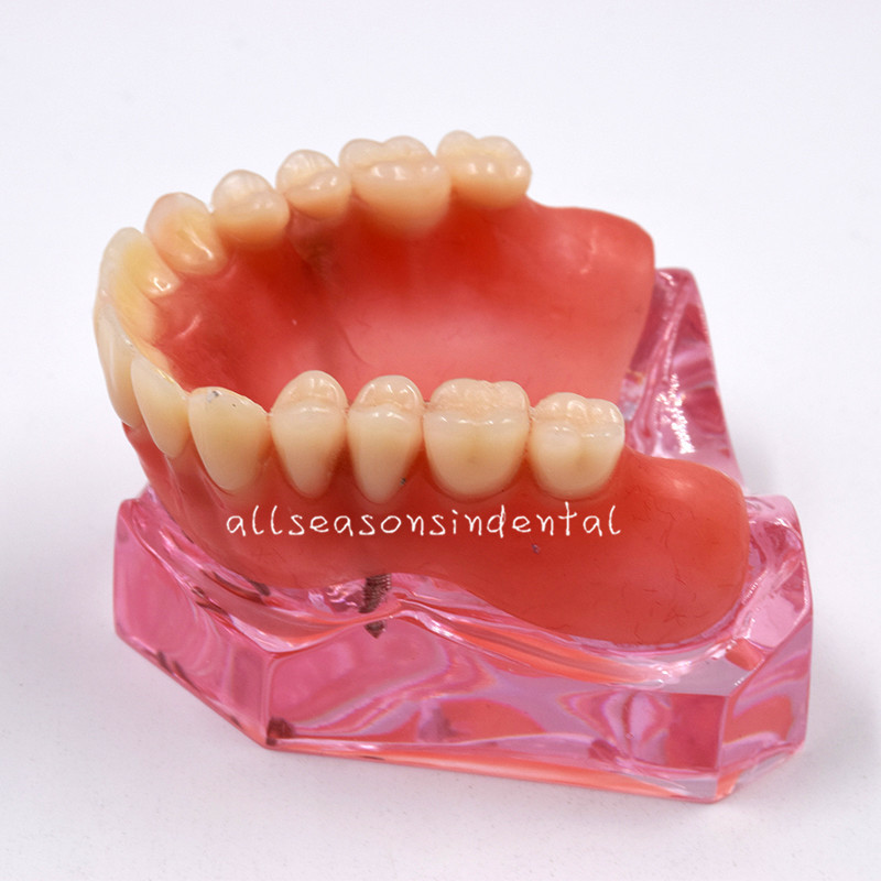 Dental Restoration Study Teach Model Overdenture Inferior Implant Teeth 7 Types