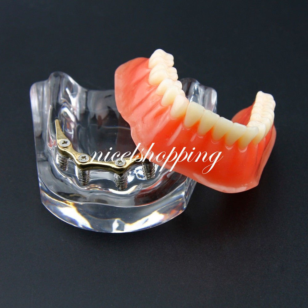 Dental Inferior Overdenture Model Lower Precision Implants With Silver Bar #6009