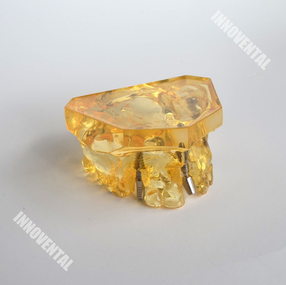 Dental Model #2011 02 - Upper Jaw Implant Model