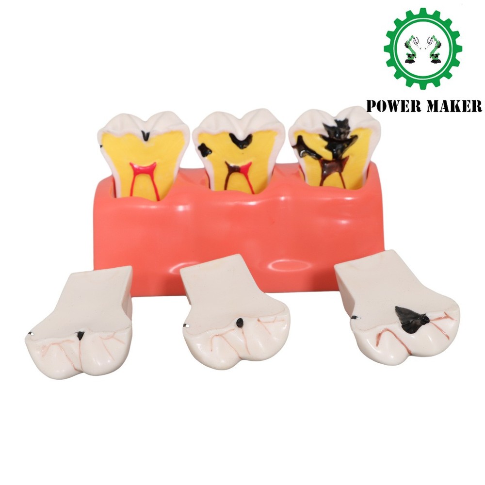 3 Stage Dental Caries Development Model Dental Model Caries Disintegration Model
