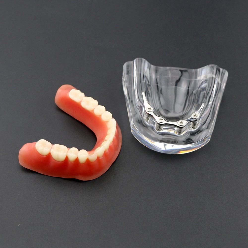 Dental Overdenture Study Demo Model Inferior M6008 Lower 4implants Silver Teeth
