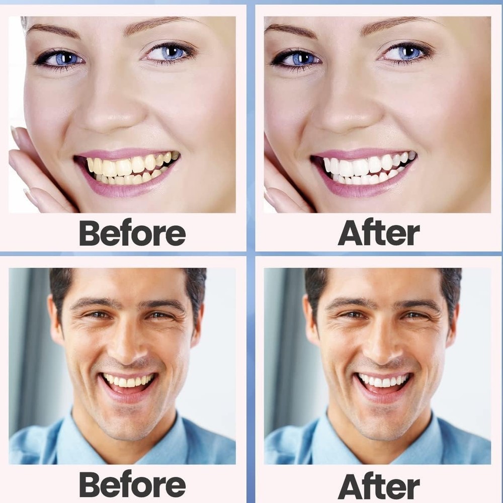 28PCS 5D Teeth Whitening Strips Tooth Rapid Bleaching White Strips Teeth White