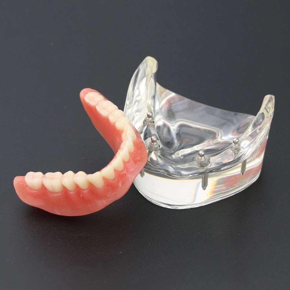 Dental Implant Overdenture Restoration Typodont Upper/Lower Teeth Models