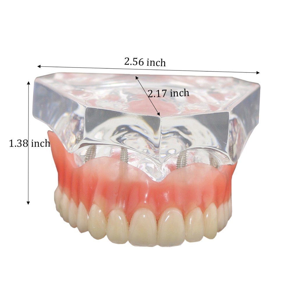 Detal Typondont Restoration Implant Overdenture Teeth Model 2 4 Implants