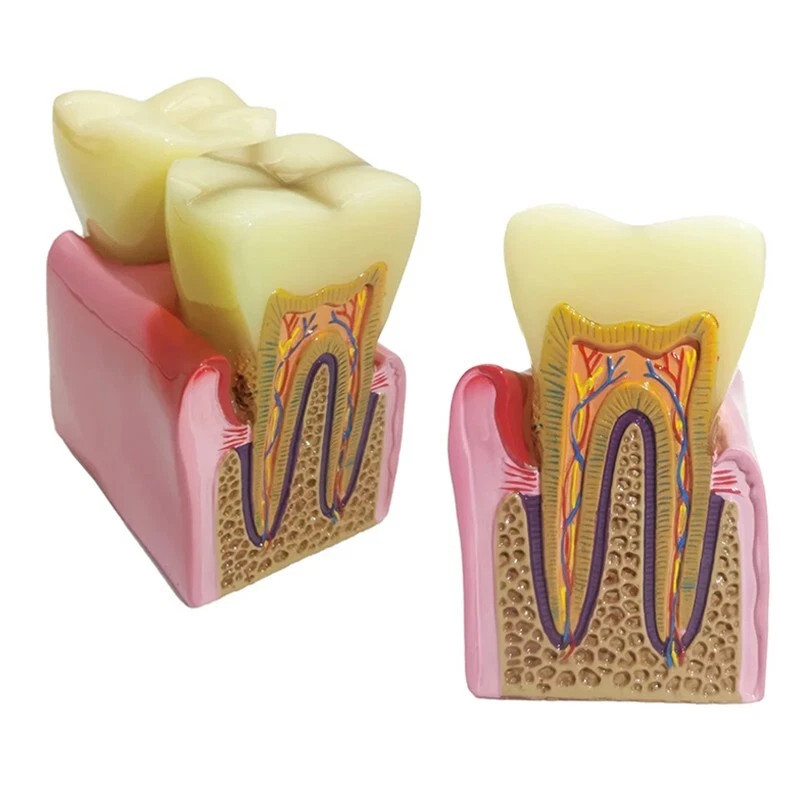 Dental Caries Disease Model Periodontitis Case Analysis Study Demo Teeth Model