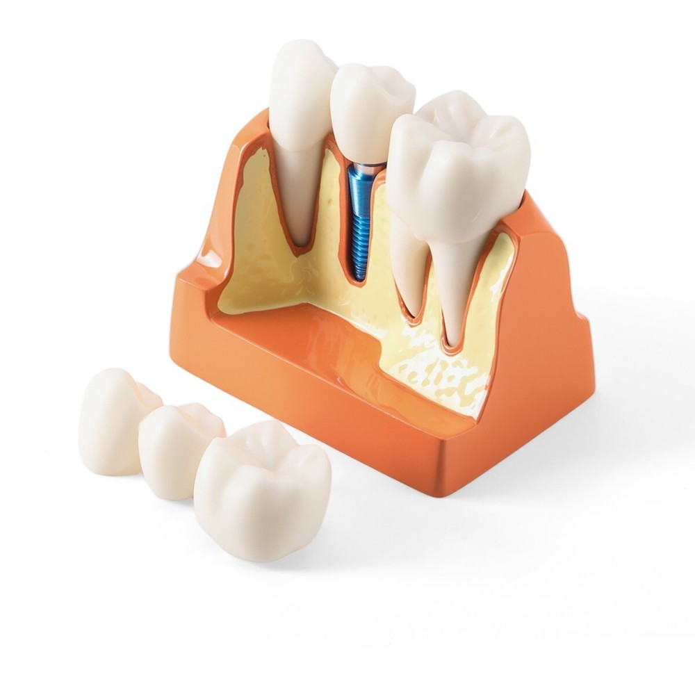 Dental Implant 4 Times Analysis Crown Bridge Demonstration Removable Teeth Model