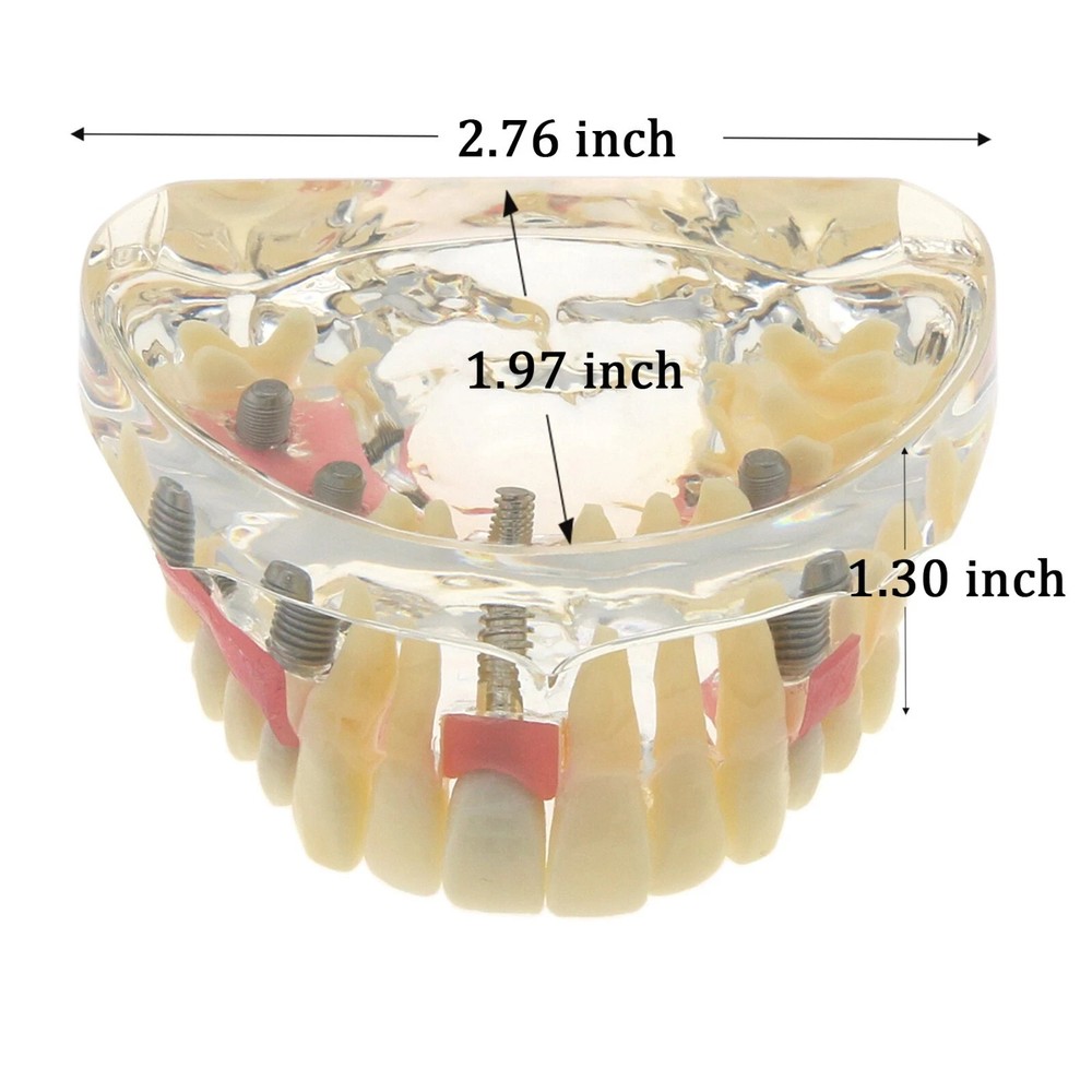 1Pcs Orthodontic Dental Implant Pathological Perio Practice Typodont Model M2005