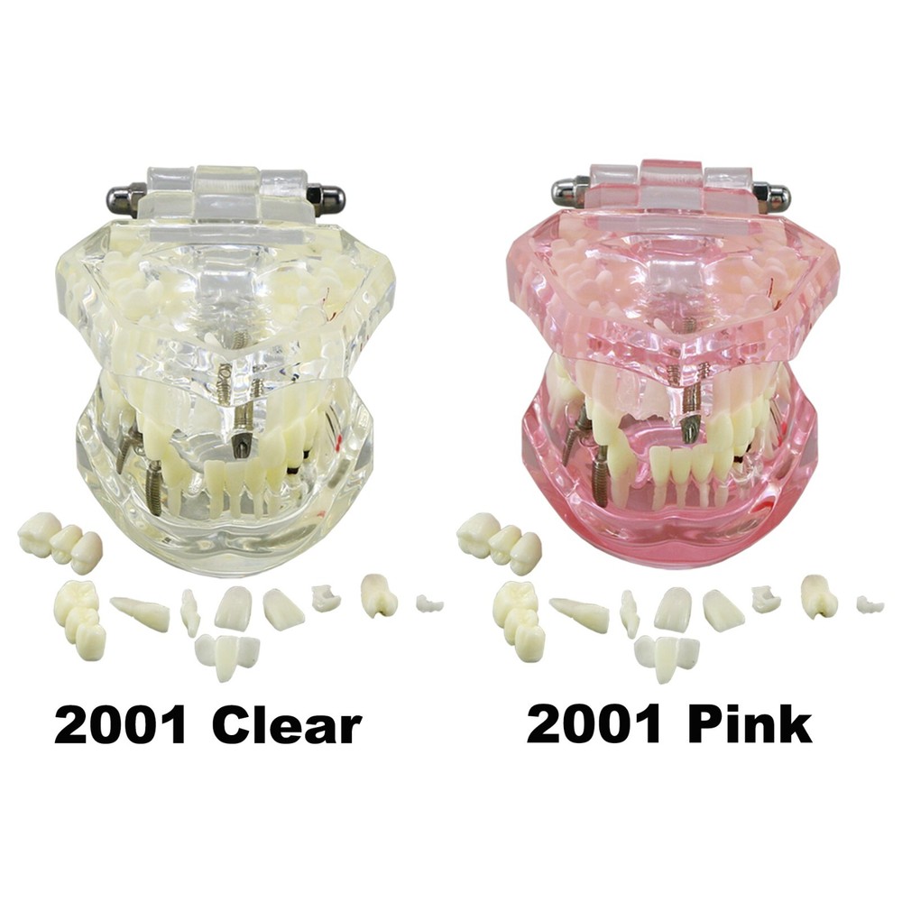 Dental Implant Disease Study Teaching Teeth Model Restoration Bridge Tooth Analy