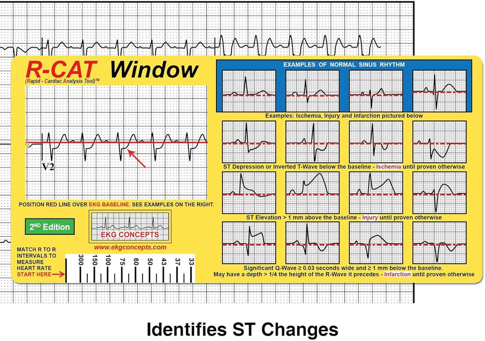 EKG Window 2Nd Edition