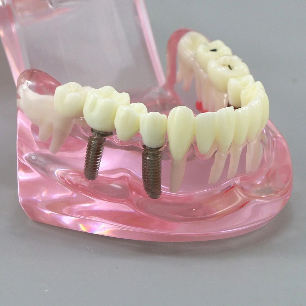 Dental Teeth Model Multiple Types Ortho Implant Practice Teaching Demo Model
