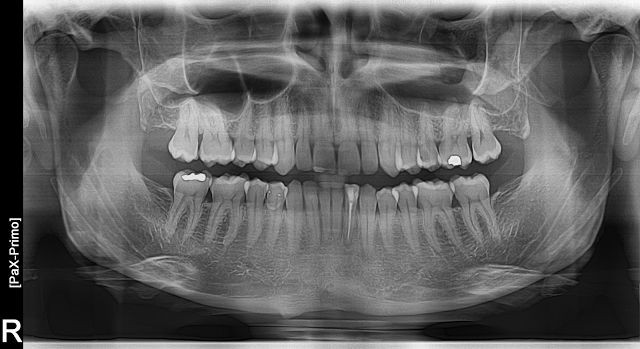 scanx 15x30cm air techiques phosphor imaging plate