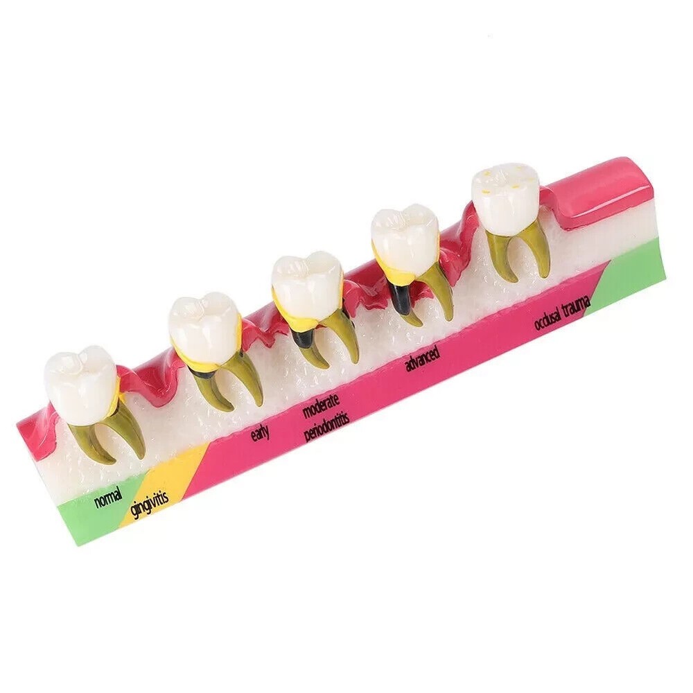 Dental Study Teaching Model Periodontal Disease 5-Stage Teeth Dentoform Typodont