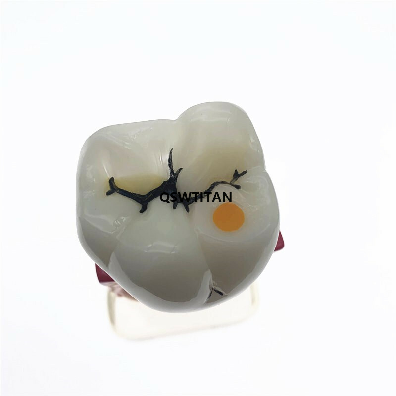 Teeth Model 4 times tooth pathology model Periodontal Teaching Study model