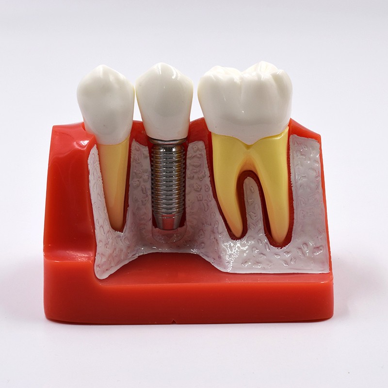 Dental Implant Analysis Crown Bridge Demonstration Teeth Study Model Typodont