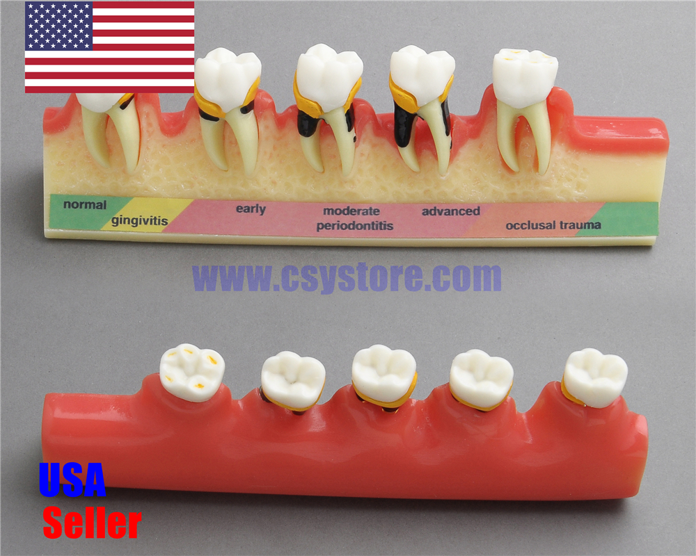 Dental Model #4010 01 - 5-Stage Periodontitis Model