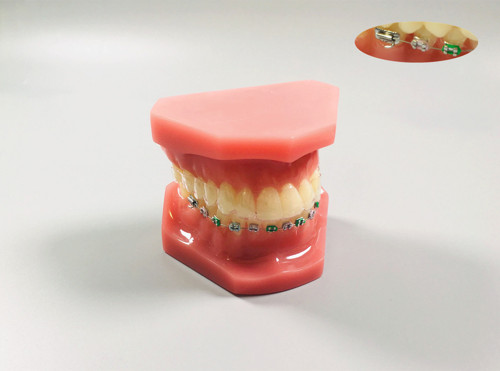 1Pc Dental Model Invisible Retainer Metal Brackets Contrast Aligner Comparison