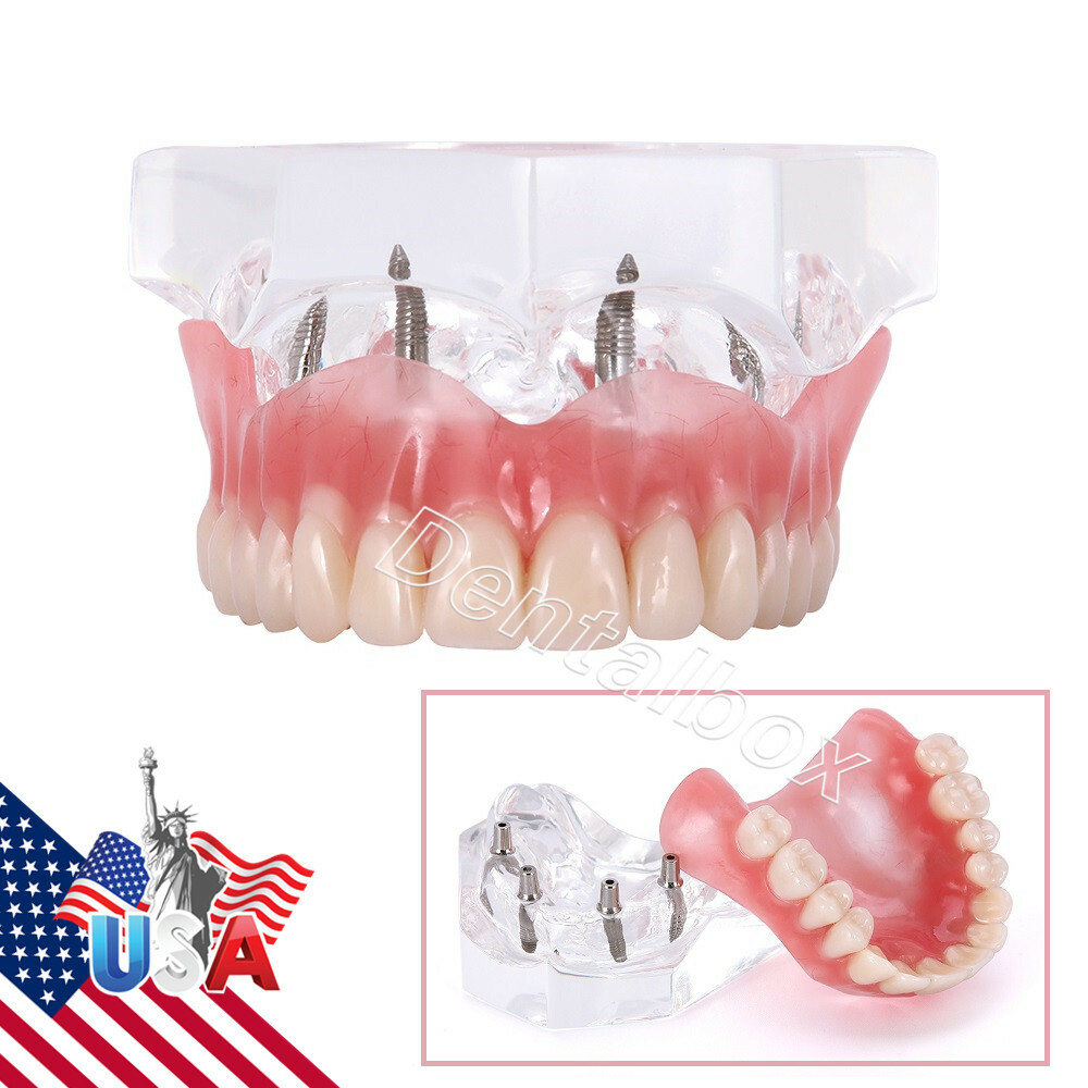 Dental Implant Upper Teeth Model Demo Overdenture Restoration with 4 Implants