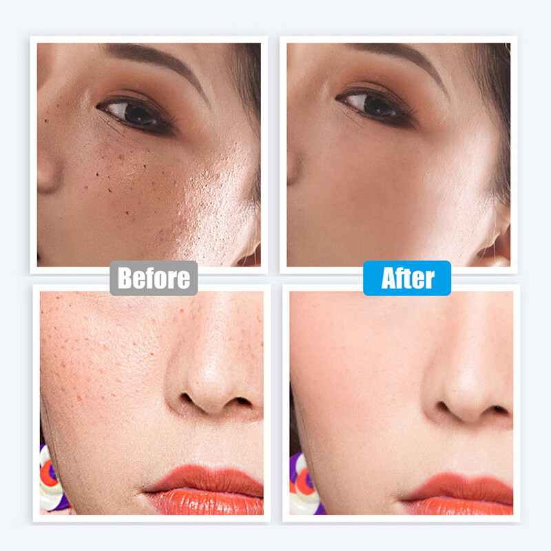 Dark Spot Remover Mole Replace Needles For Laser Tattoo Removal Machine