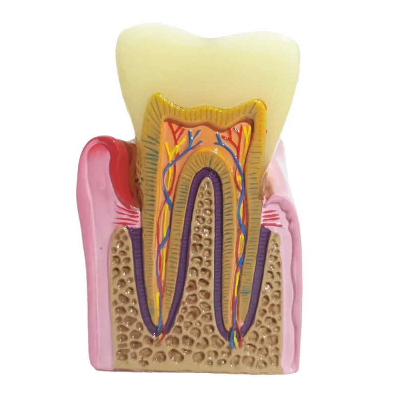 Dental Caries Disease Model Periodontitis Case Analysis Study Demo Teeth Model