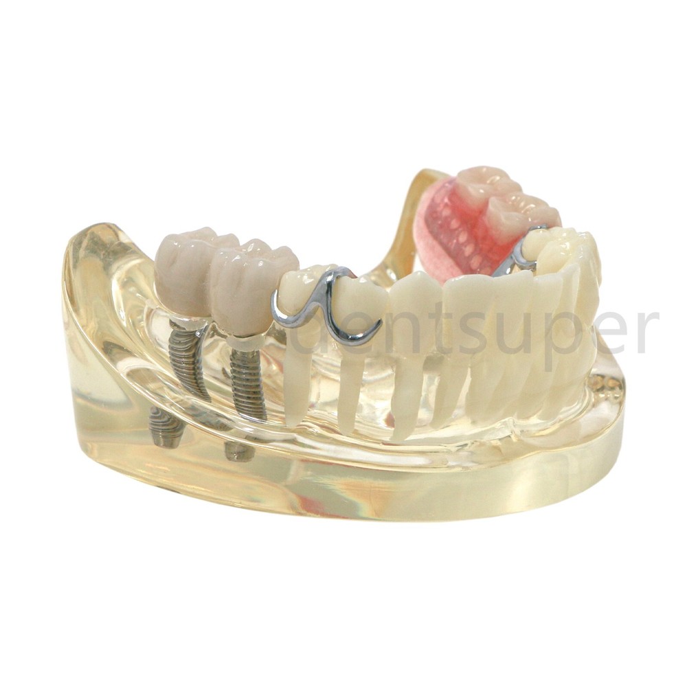 Typodont Restoration Dental Teeth Model With Partial Denture Demo 2 Implants