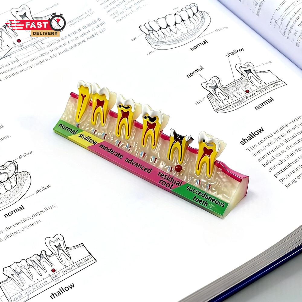 6-Stage Dental Caries Development Model - Anatomical Teeth Decay Demonstration w