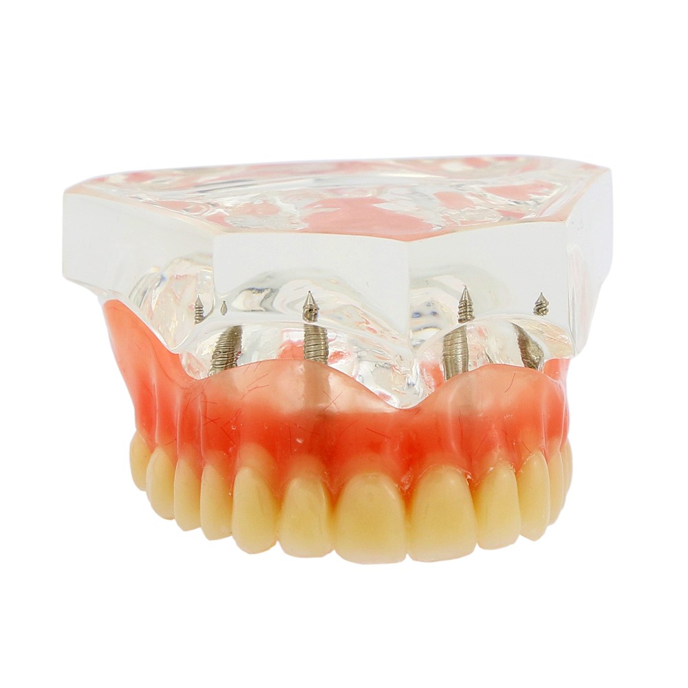 Dental Implant Teeth Model Restoration Overdenture Upper/Lower 4 Implants Demo