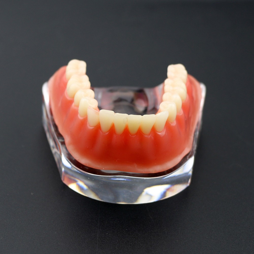 Dental Teeth Model Inferior Overdenture Precision 4 Implants Demo Silver Bar