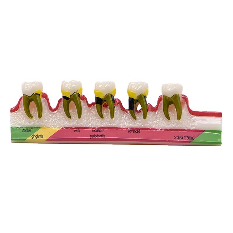 Dental Study Teaching Model Periodontal Disease Assort Teeth Dentoform Typodont