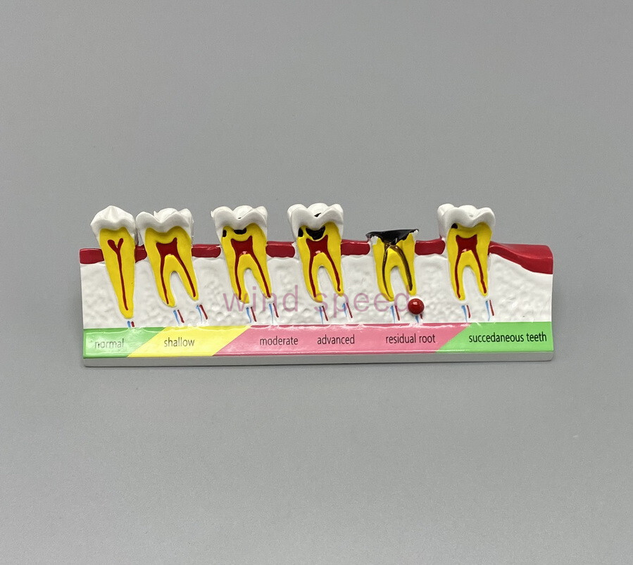 Dental Teeth Dentoform Typodont Caries Periodontal Disease Study Teaching Model