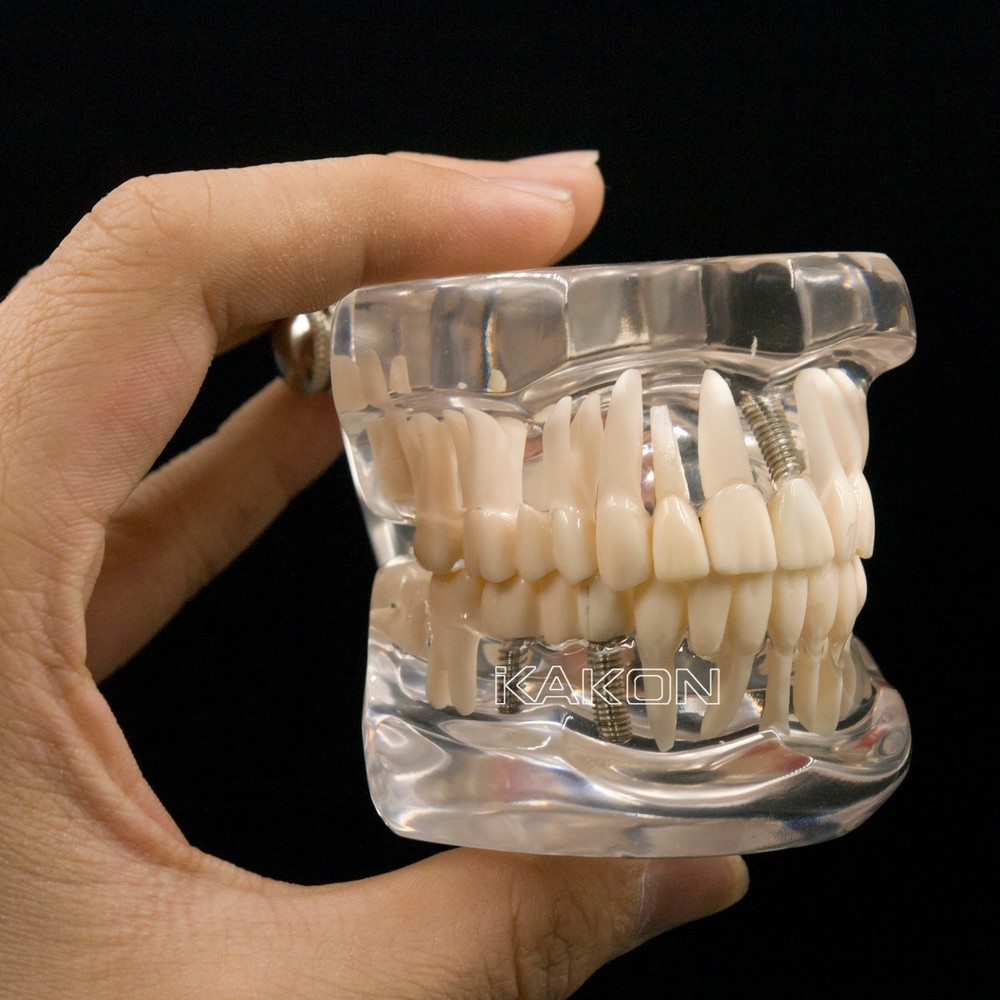 Dental Implant and Restoration Model Transparent Pathological Teeth Study Model