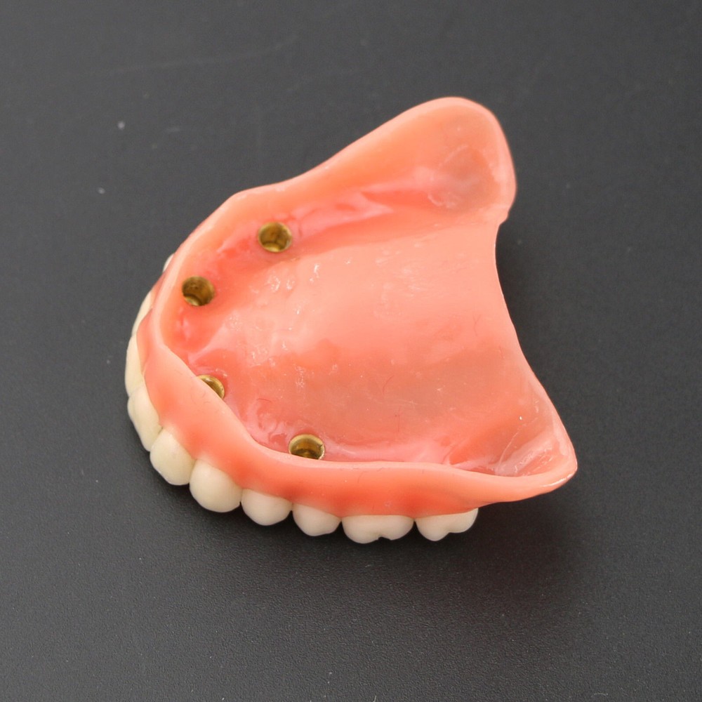 Dental Teeth Model Demo Overdenture Restoration With 4 Implants Upper Maxillary