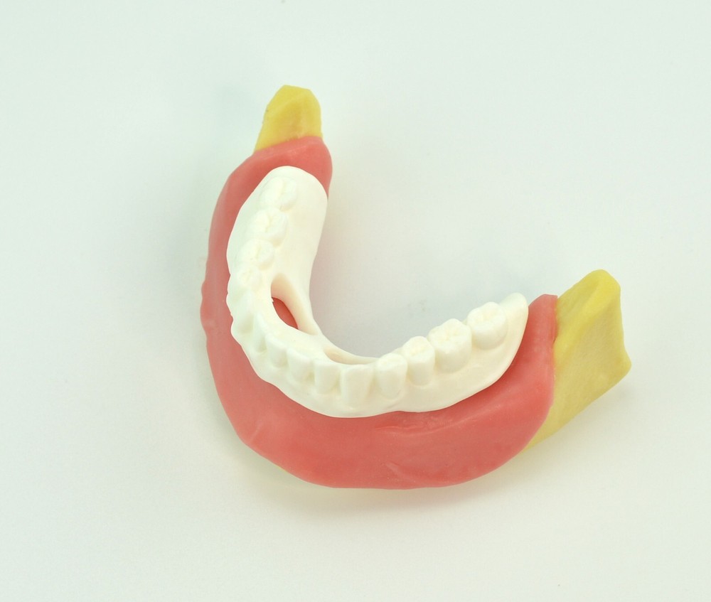 Dental Mandibular Implant Plus Denture Training Model Implant Placement