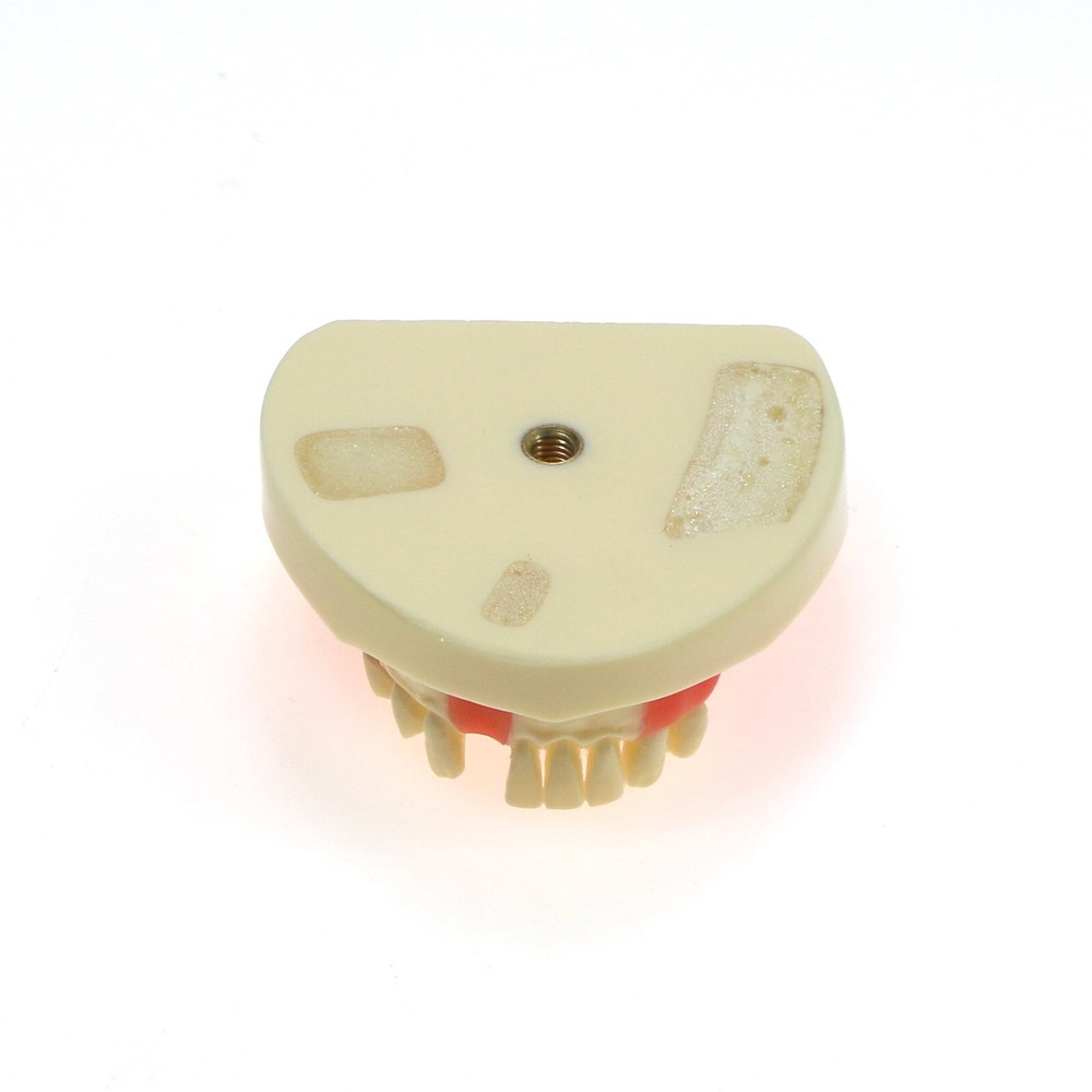 Implant Teeth Model Dental Typodont Ortho Pathological Perio Practice Demo Model