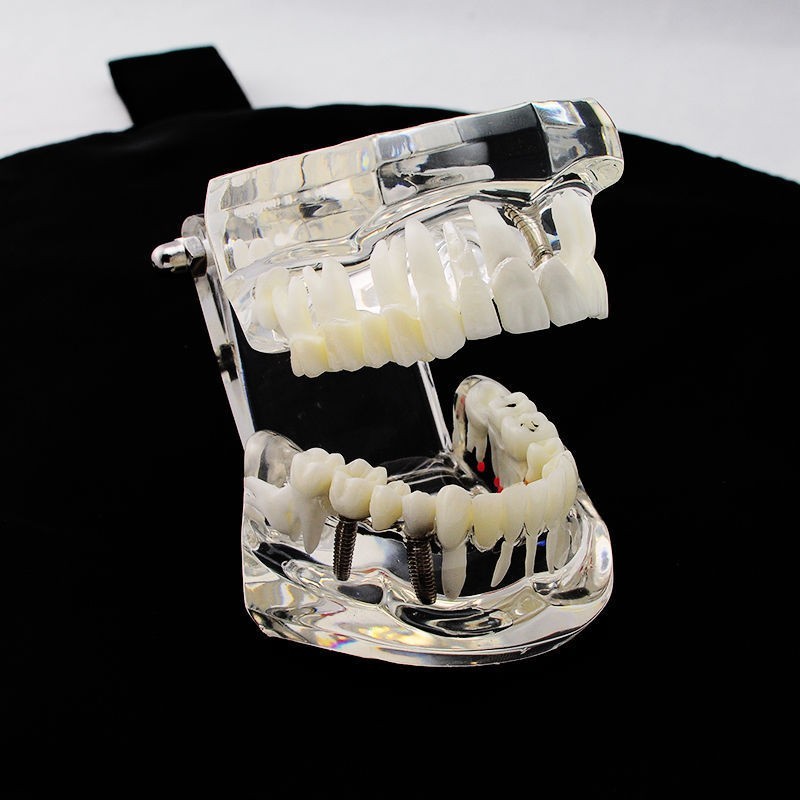 Dental Teeth Model With Restoration&Bridge Implant Disease Study Teaching Model