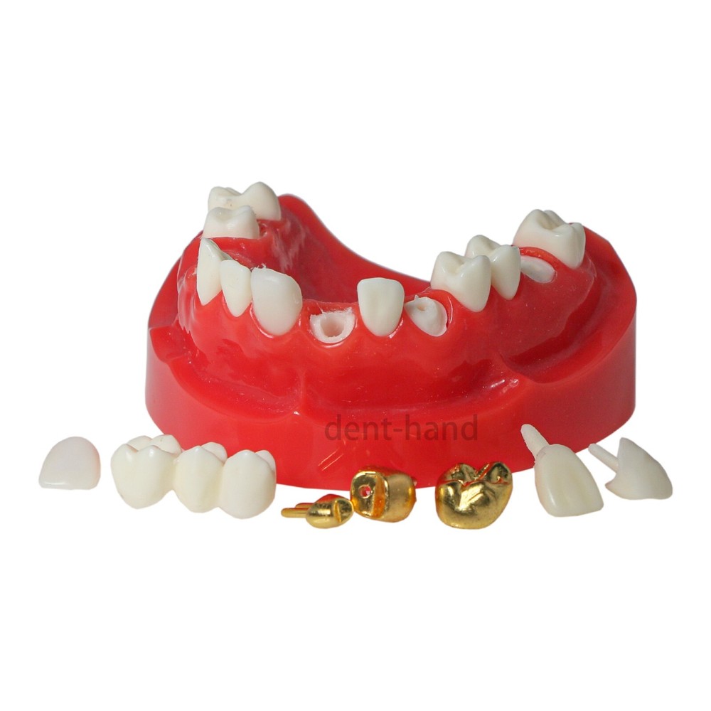 Dental Typodont Teeth Model Restoration Crown with Post Core Bridge M6004