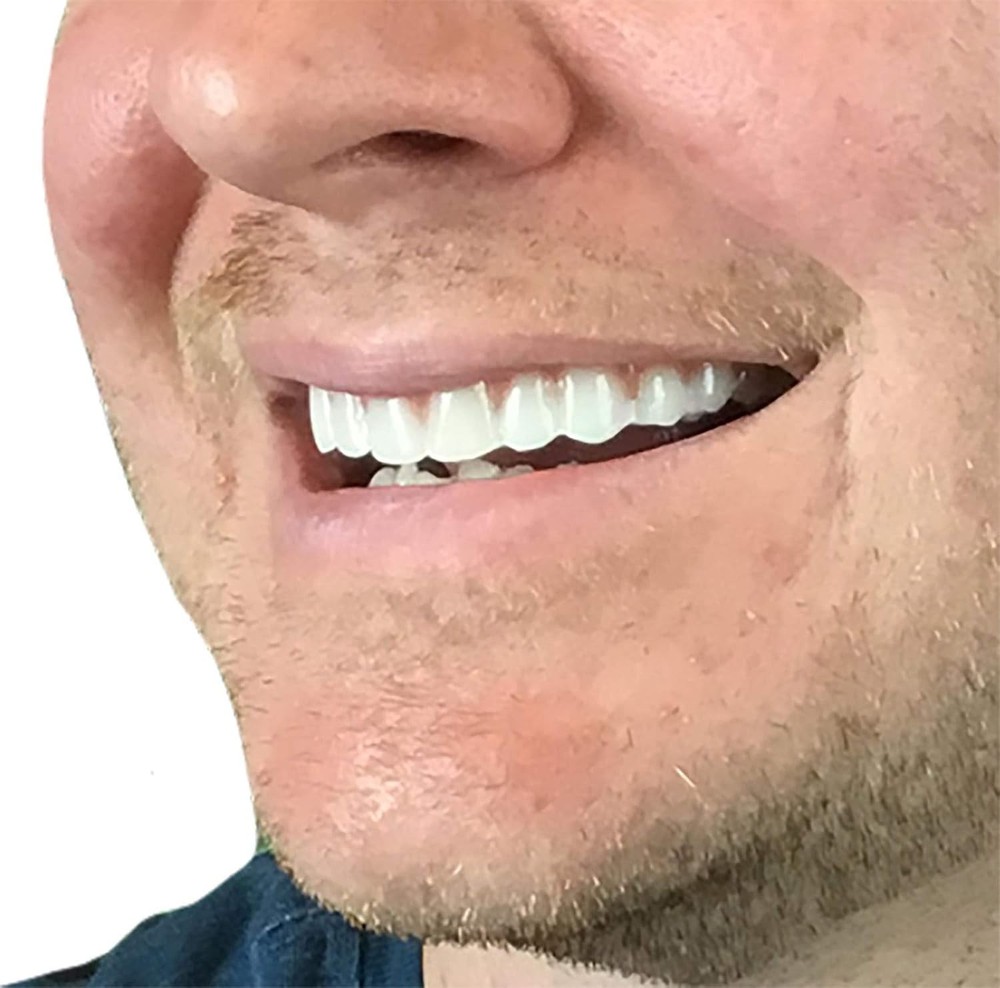 Easy Fitting Cosmetic Veneers - Comfortable Fit