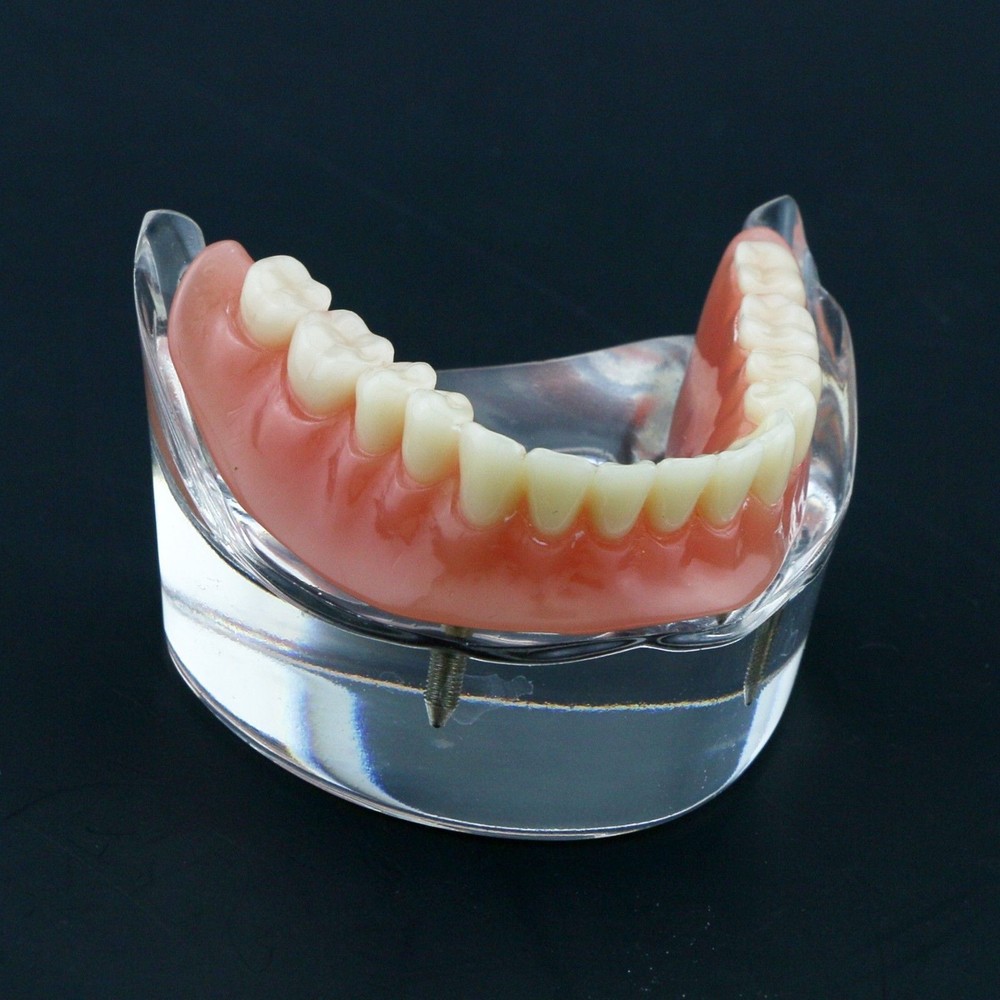 Dental Oral Transparent Upper Teeth 2/4 Implants Model Overdenture Restoration