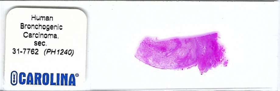 Human Bronchogenic Carcinoma  Pathology Microscope Slide