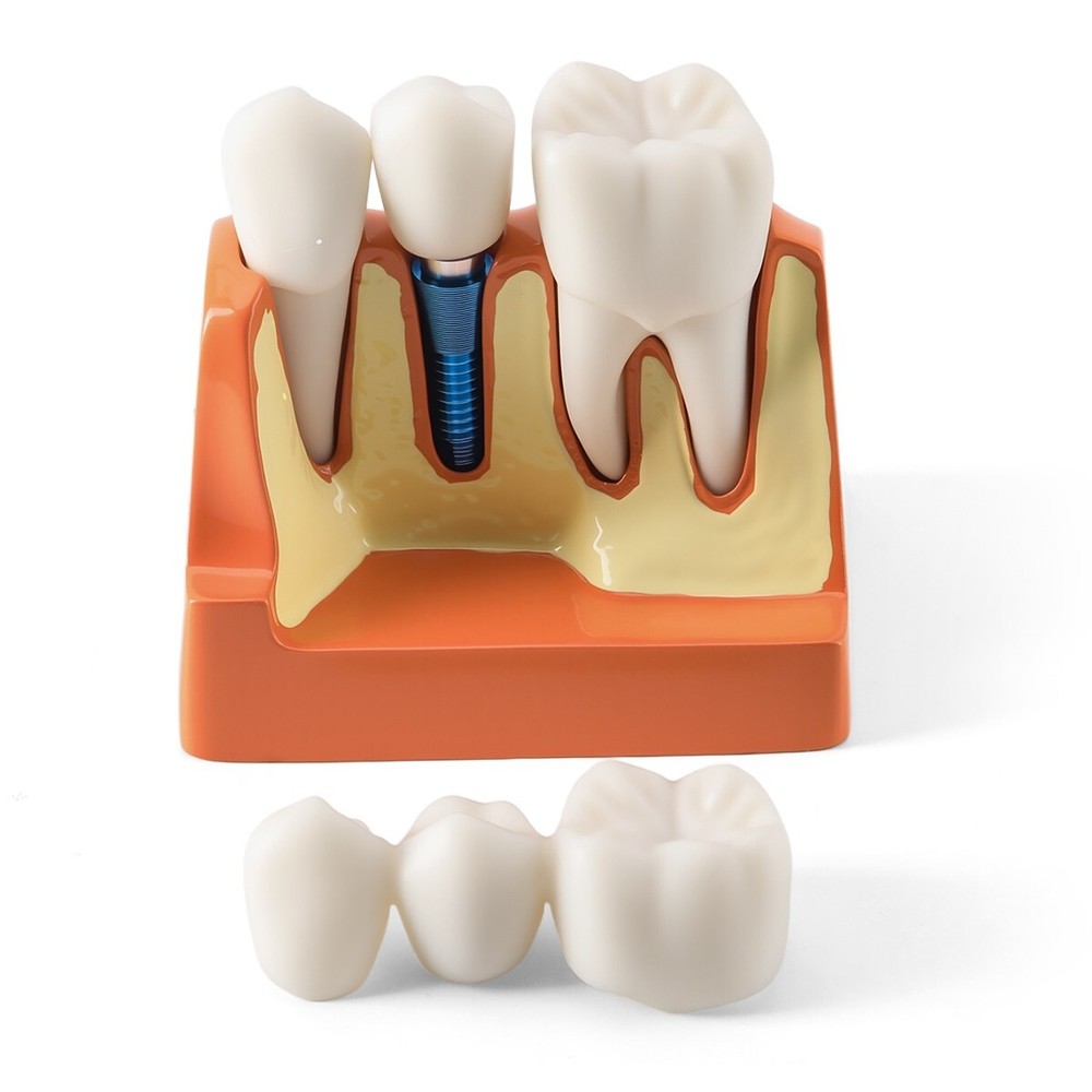 4 Times Dental Analysis Crown Bridge Demonstration Removable Teaching Model