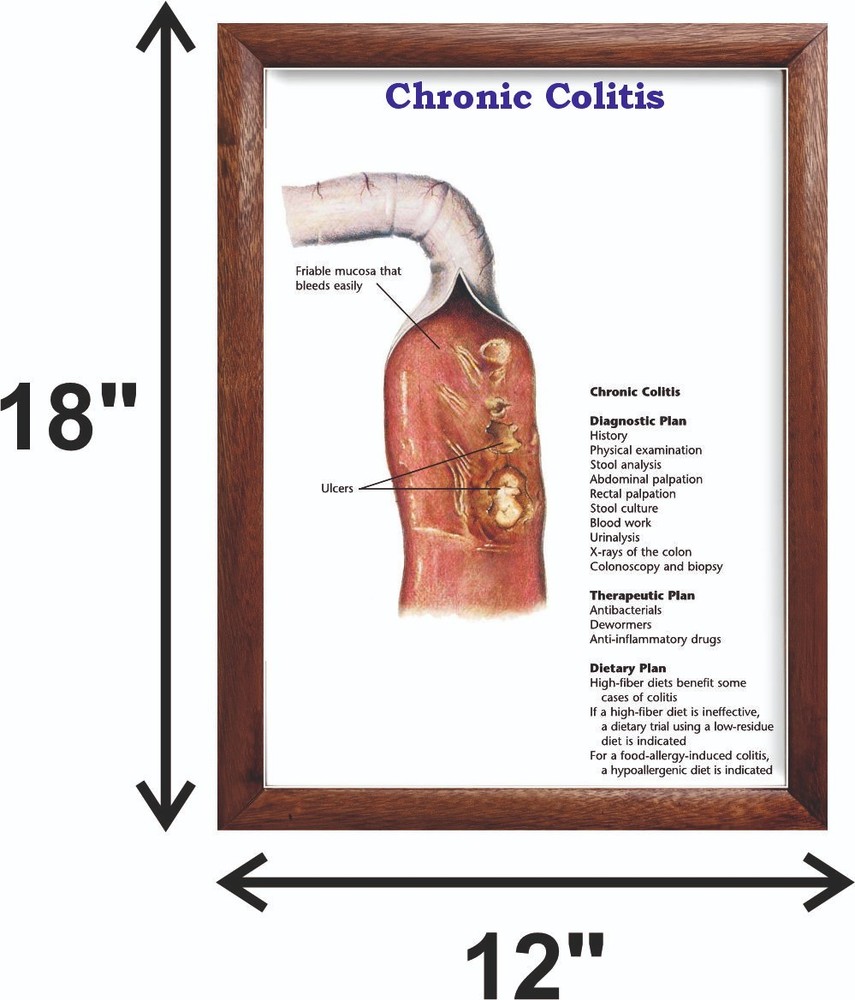 Chronic Colitis Chart 12x18 inches