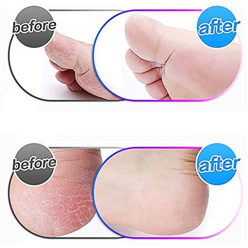 6 Pack Blue Extra Coarse Replacement Roller Refills 1 Count (Pack of 6),