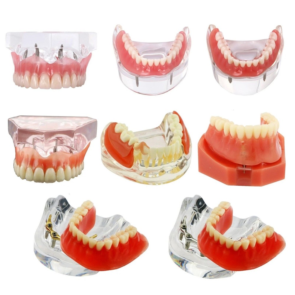 Dental 2/4 Implants Upper Lower Teeth Model Lower Demo Overdenture Restoration