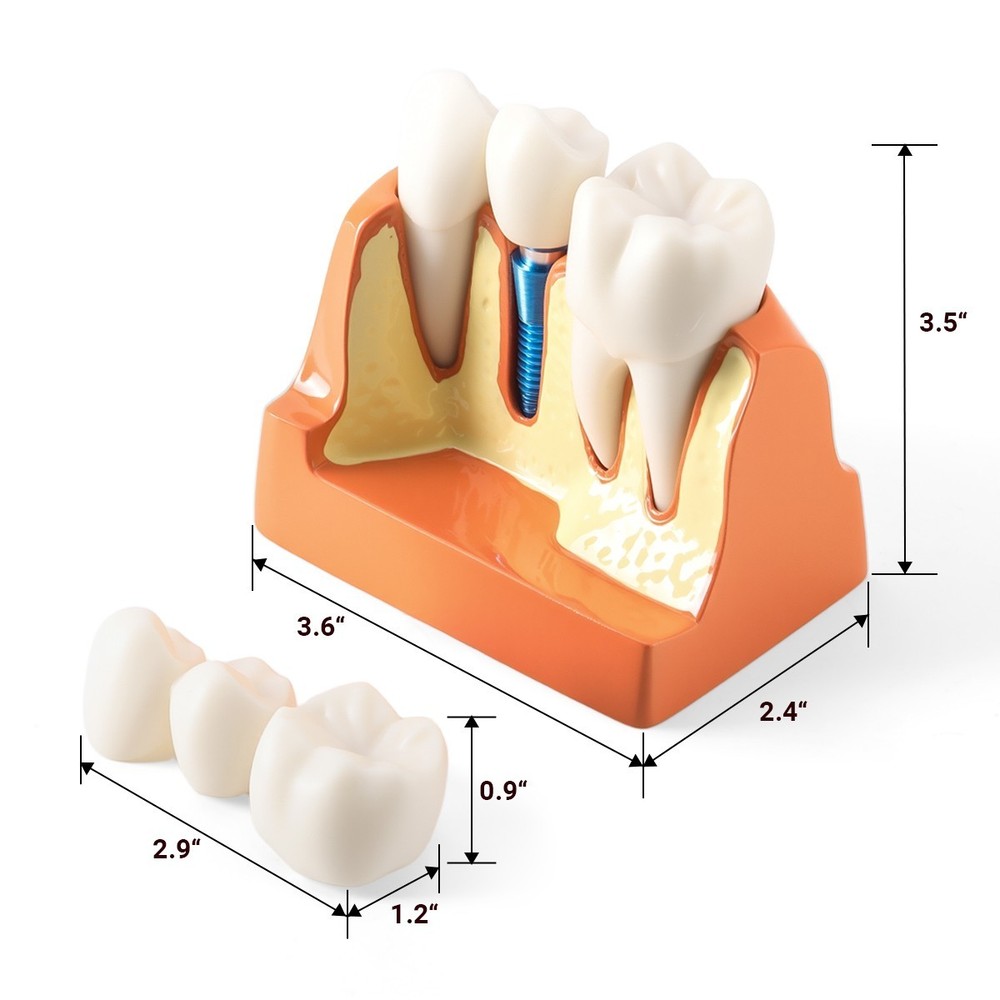 4 Times Dental Teeth Model Implant Crown Bridge Removable Study Teaching Tool