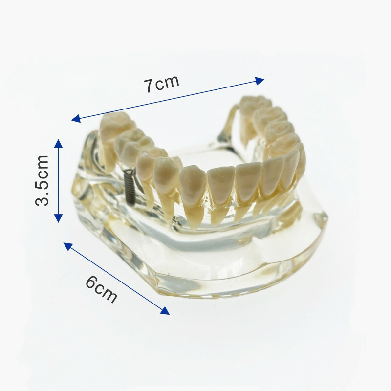 Teeth model with bridge and caries Dental implant model Upper/Lower Jaw model