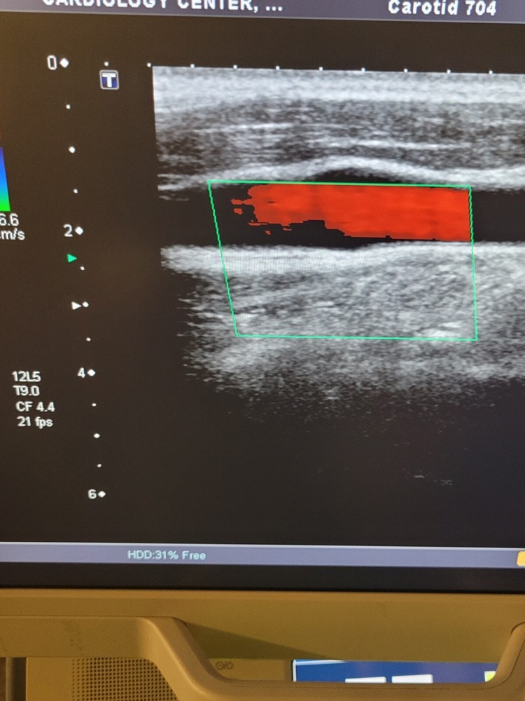 Toshiba PLT-805AT Linear Array Ultrasound Transducer Probe