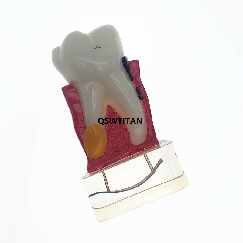 Teeth Model 4 times tooth pathology model Periodontal Teaching Study model