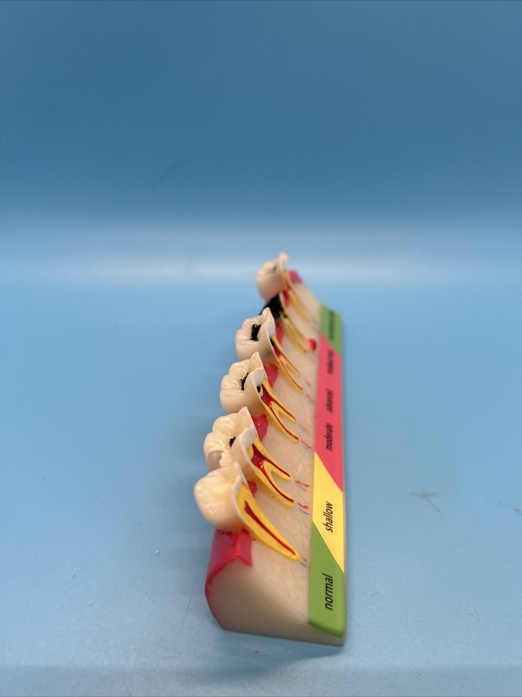 Dental Caries Developing illusteation teeth disease Tooth Model Demonstration