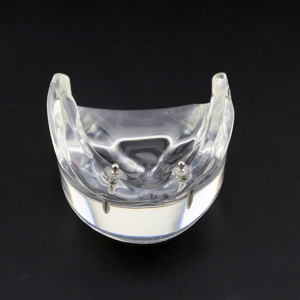 Dental Oral Transparent Upper Teeth 2/4 Implants Model Overdenture Restoration