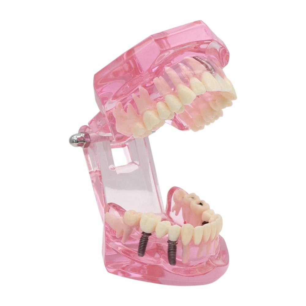 Dental Teeth Model Multiple Types Ortho Implant Practice Teaching Demo Model